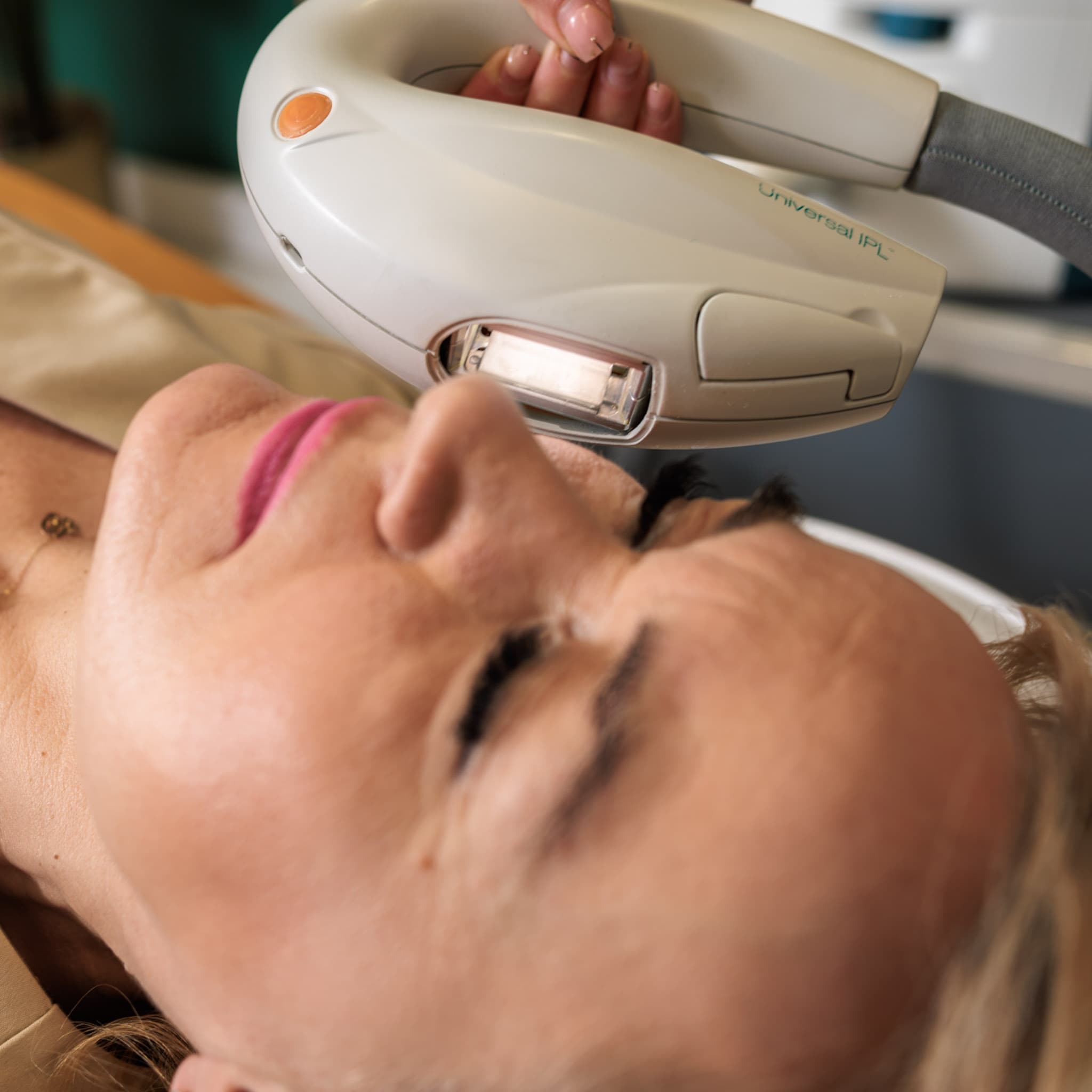w trakcie zabiegu laserowego usuwania przebarwień ipl w salonie kosmetycznym w krakowie