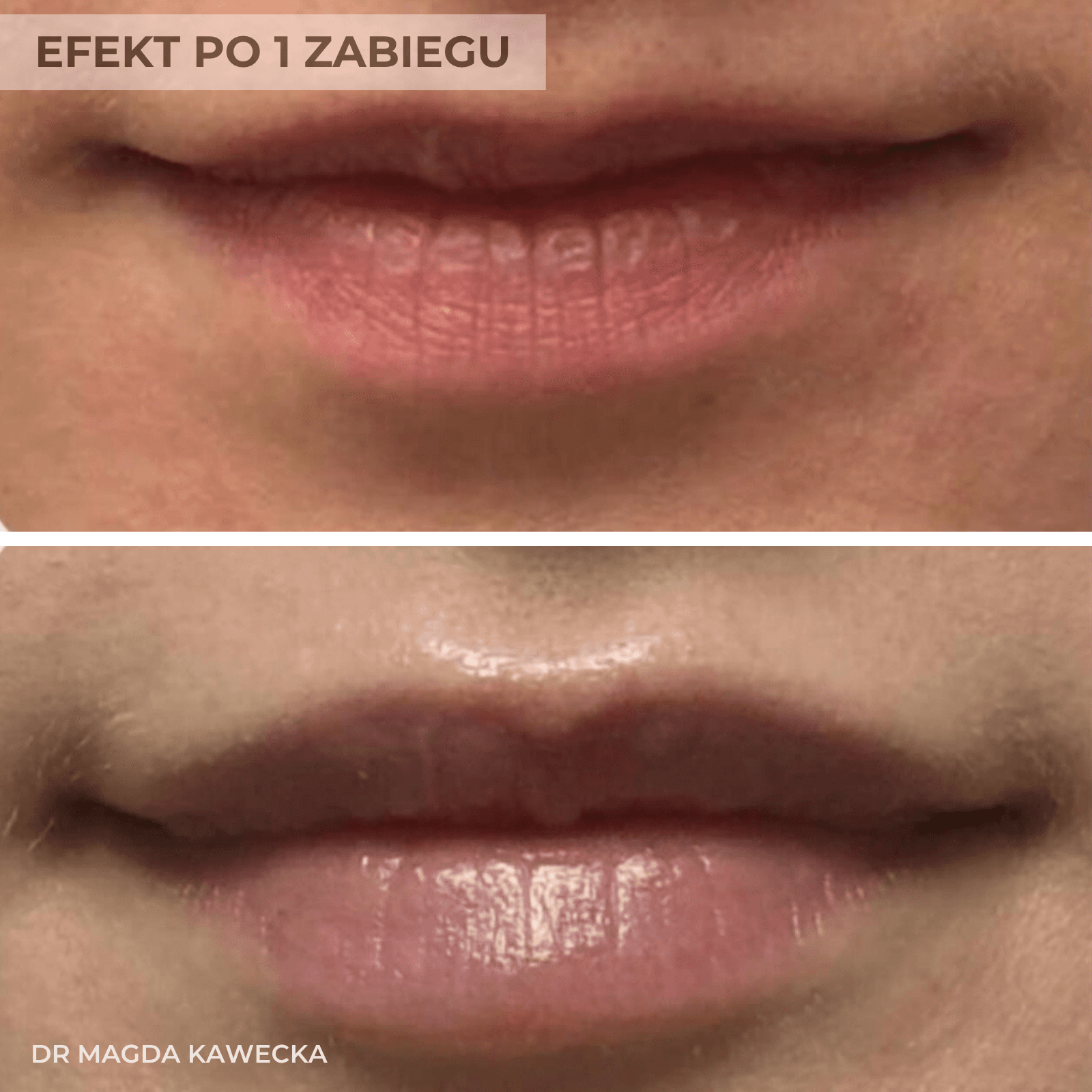 efekt przed i po powiekszaniu ust przez lekarza medycyny estetycznej