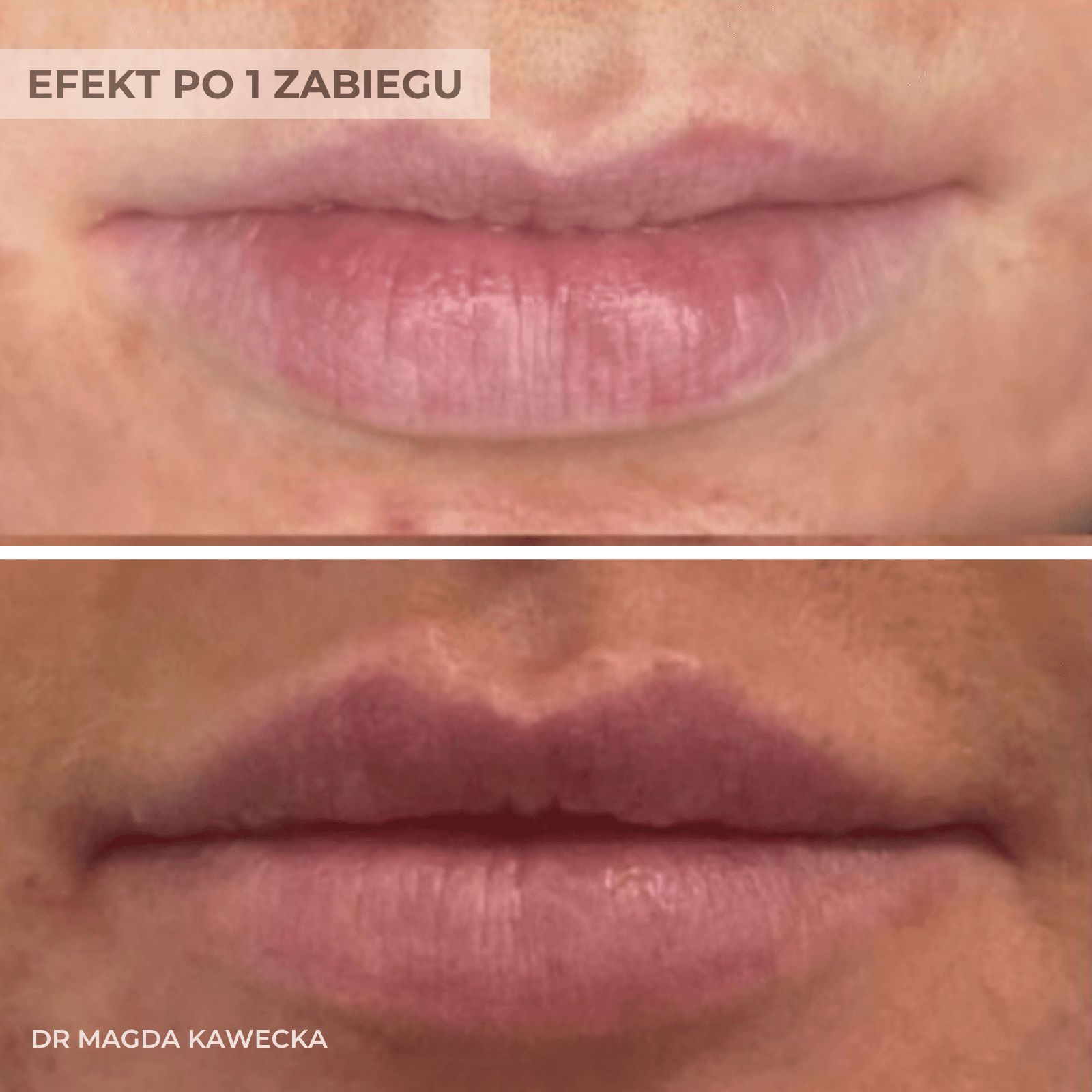 efekt przed i po jednym zabiegu powiekszaniu ust przez lekarza